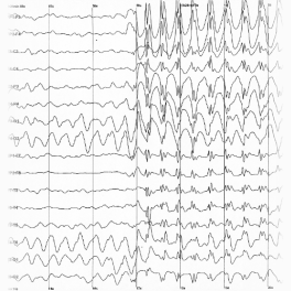 Epilessia, bisogna sfatare ogni luogo comune
